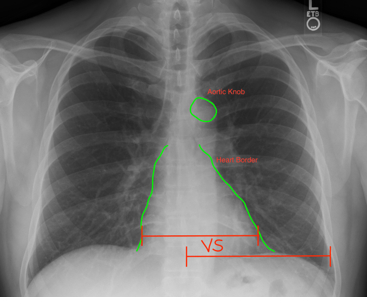 Chest_Xray_PA_3-8-2010-2.png