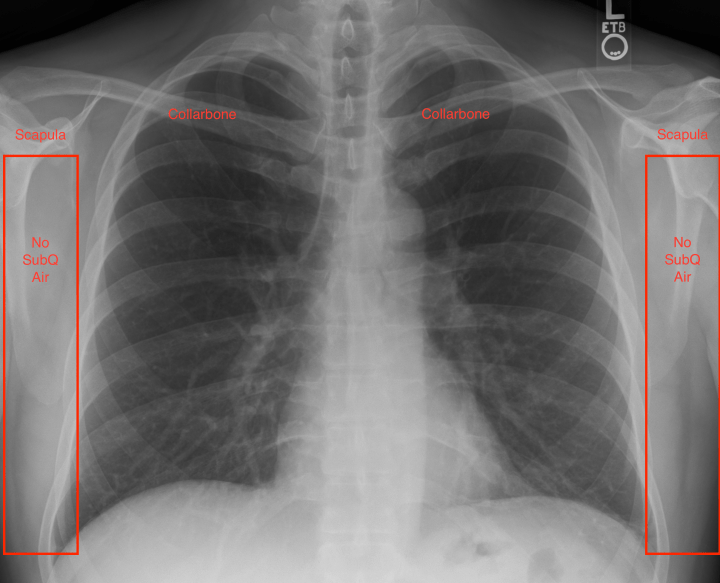 Chest_Xray_PA_3-8-2010 xx.png